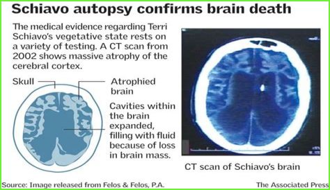What Happened To Terri Schiavo Brain? Autopsy Reveal And Documentary Details